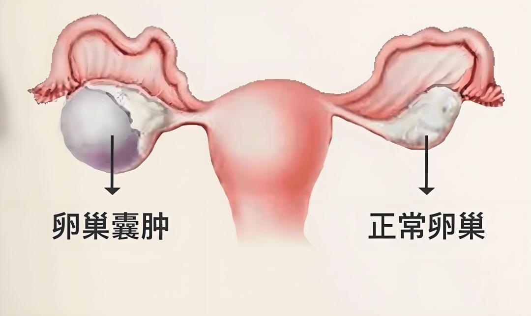 卵巢囊肿中医怎么治疗？新加坡贡方堂TCM丘保润有消囊方！