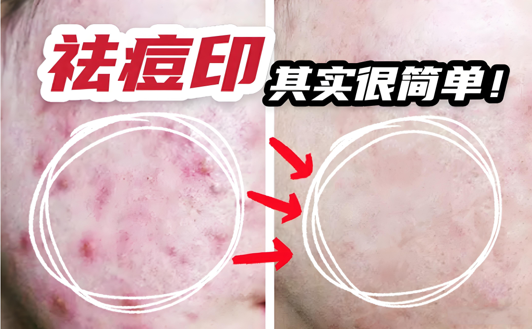 痘痘痘印怎么办？新加坡贡方堂TCM中医丘保润送你内服外敷方有奇效！