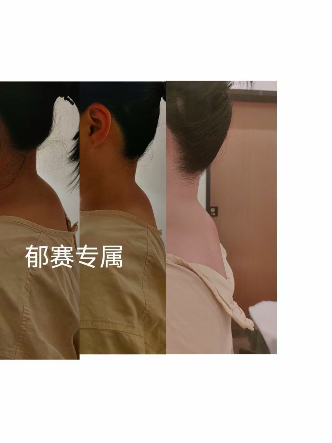 【医案】富贵包怎么调理消掉？新加坡贡方堂TCM中医康复专家结合推拿治疗“富贵包”