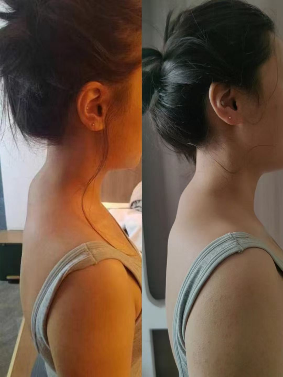 贡方堂正骨师郁赛徒手调理脖子前倾+富贵包，1次调理，重现优雅颈线！