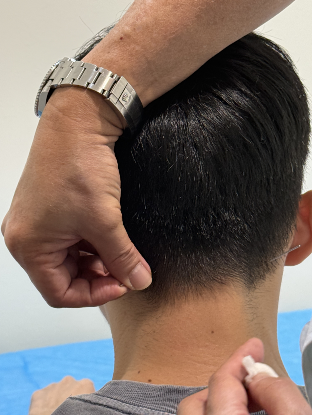 【医案】总是偏头痛怎么治？新加坡贡方堂TCM中医丘保润针药调理、外用膏药止痛！