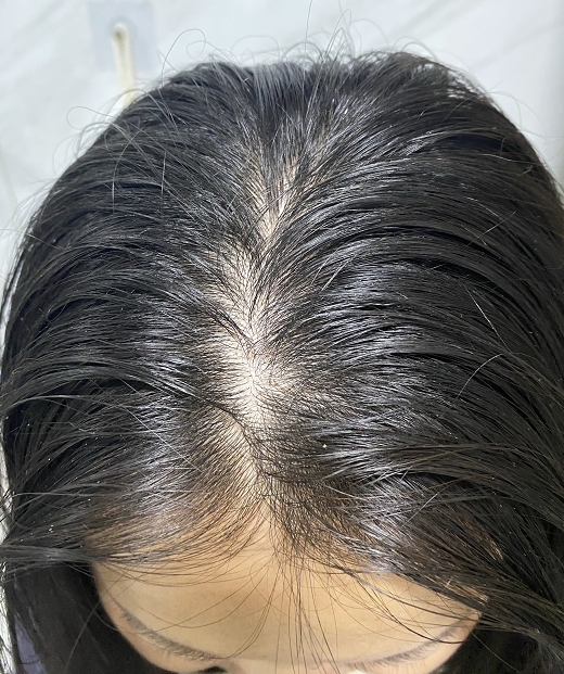 脂溢性皮炎中医怎么治疗？新加坡贡方堂TCM陈慧芳一方告别油痒头皮