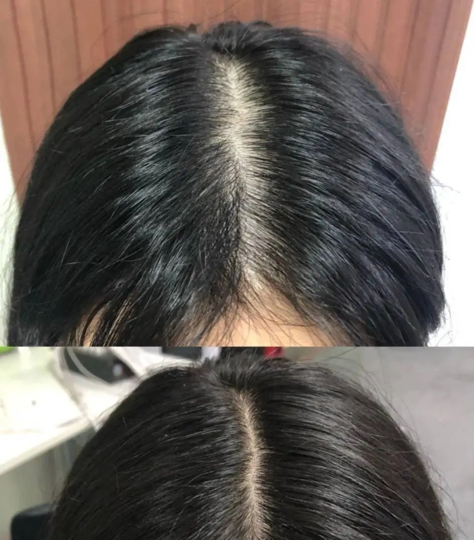 新加坡脱发困扰：头顶越来越稀、头皮越来越油？贡方堂TSHL髮愈療法™从毛囊开始养