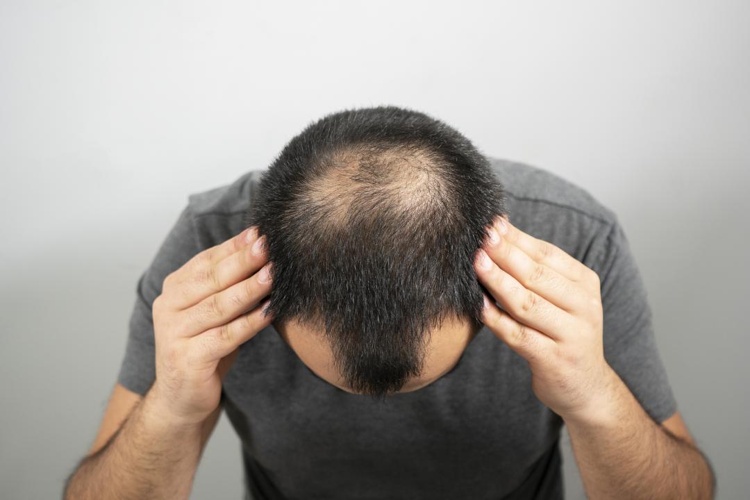 为什么男性脱发先秃头顶?新加坡贡方堂TCM中医杨婷婷一方补救,把地中海养回来 为什么男性脱发先秃头顶?新加坡贡方堂TCM中医杨婷婷一方补救,把地中海养回来